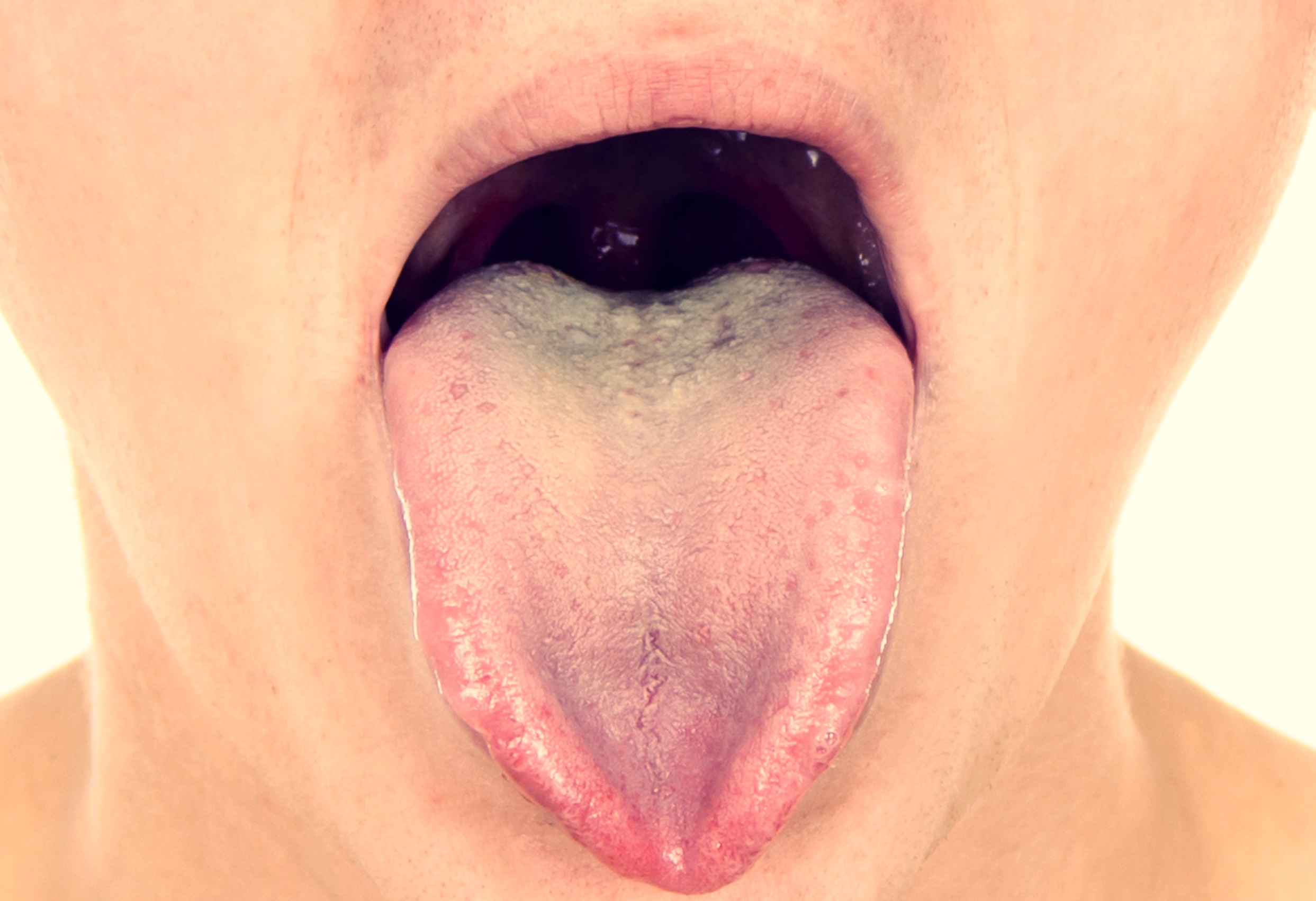 What Causes A Dry Mouth And Tongue In The Morning