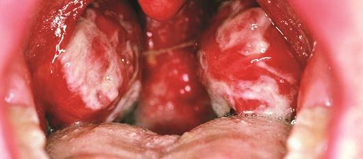 mouth, throat, dental, Epstein-Barr  virus glandular fever