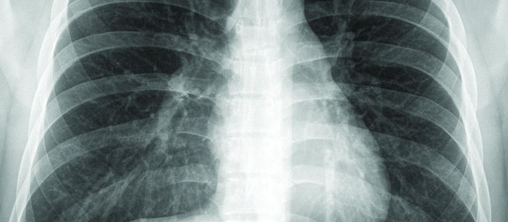 Chest x-ray