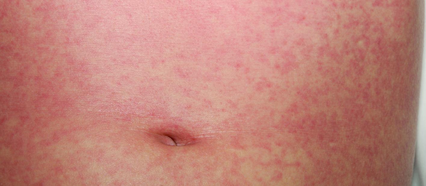 measles rash