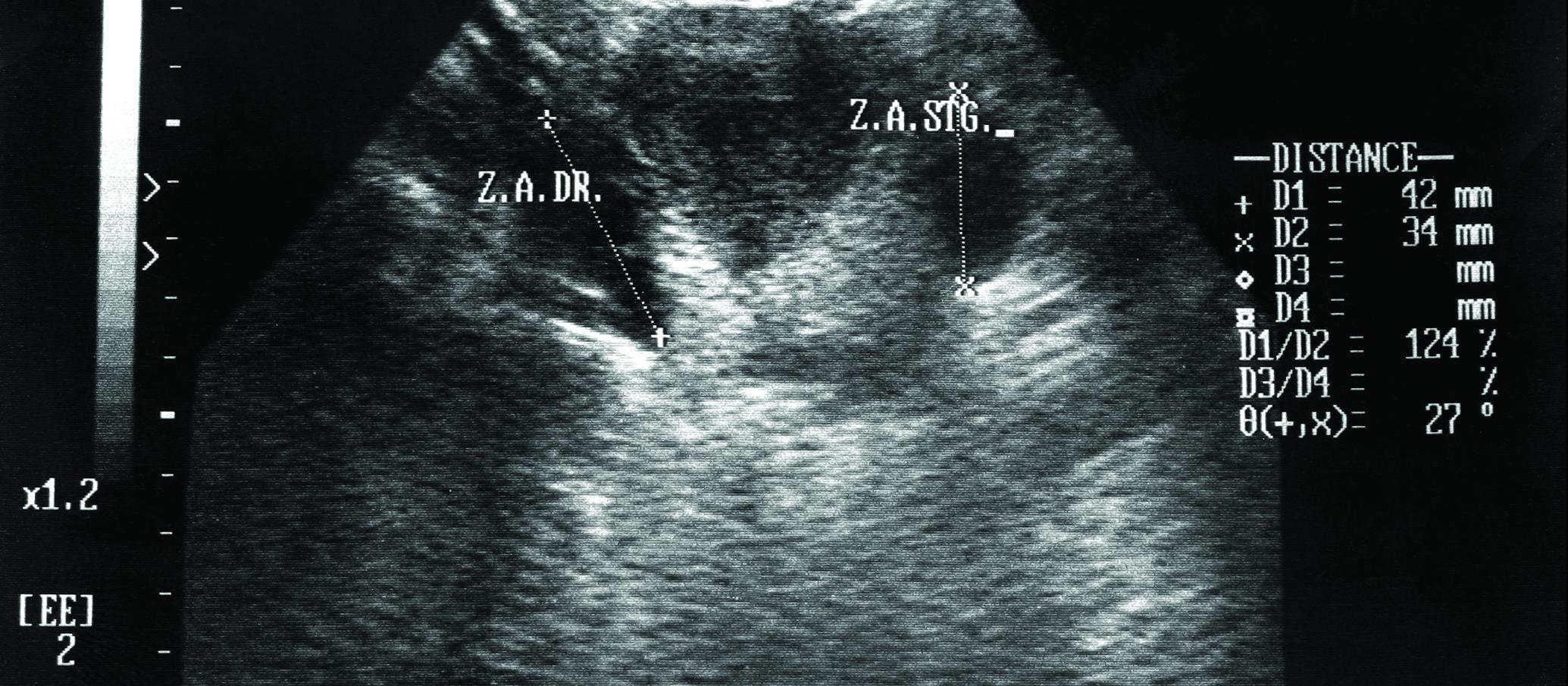 Pelvic ultrasound 