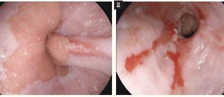 Oesophagitis