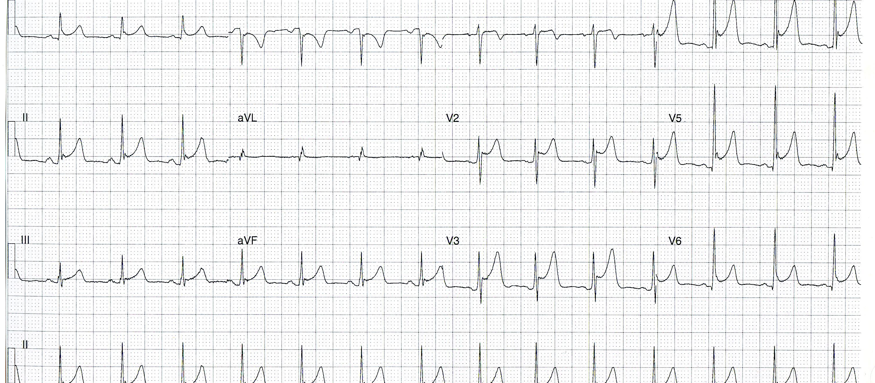 ECG