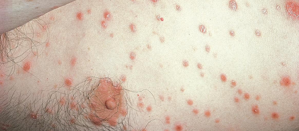 Secondary syphilis rash