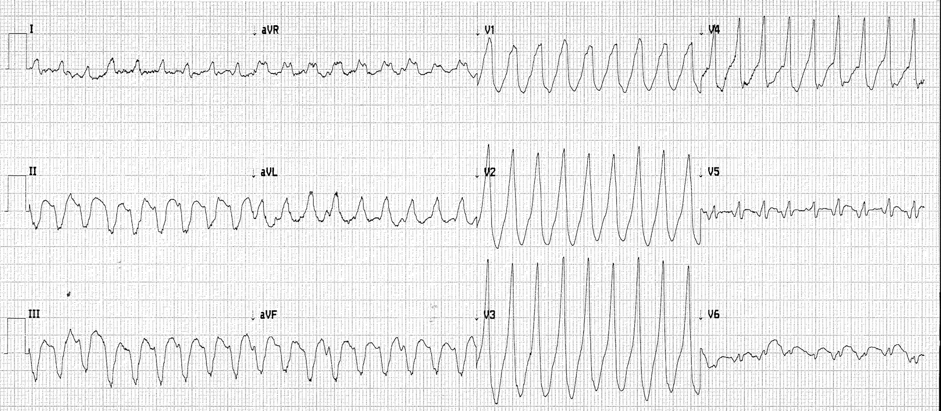 Heartbeat-ECG-260918