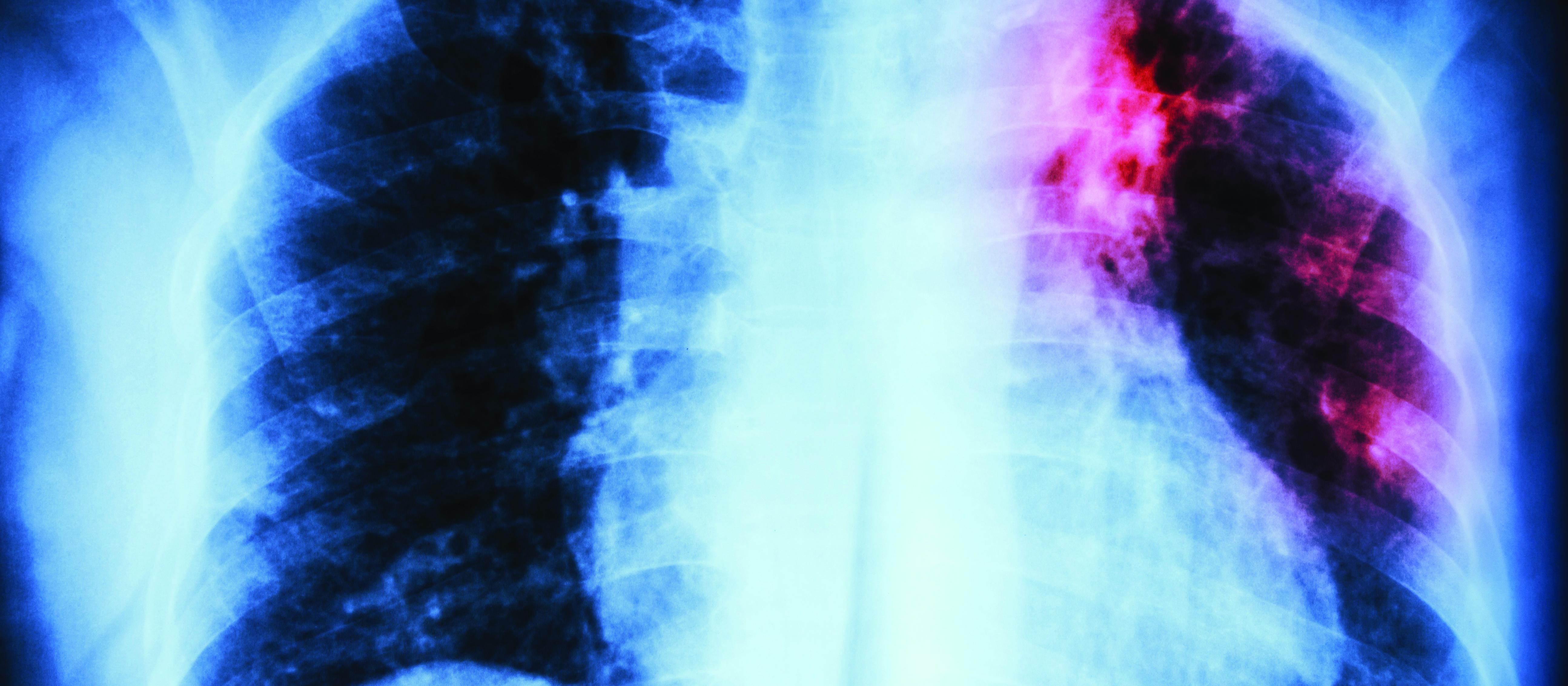 Pulmonary Tuberculosis