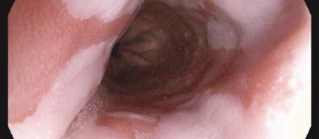 Barrett’s oesophagus