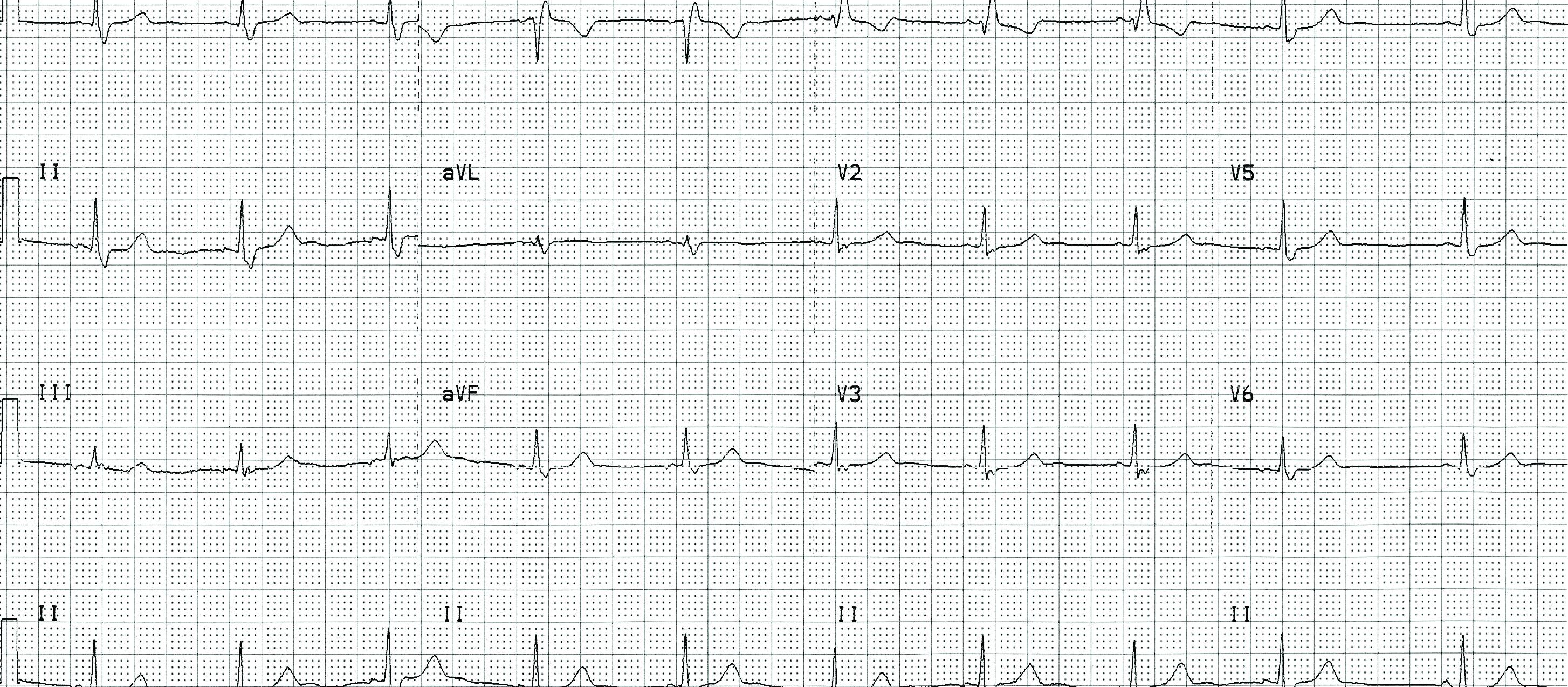 ECG