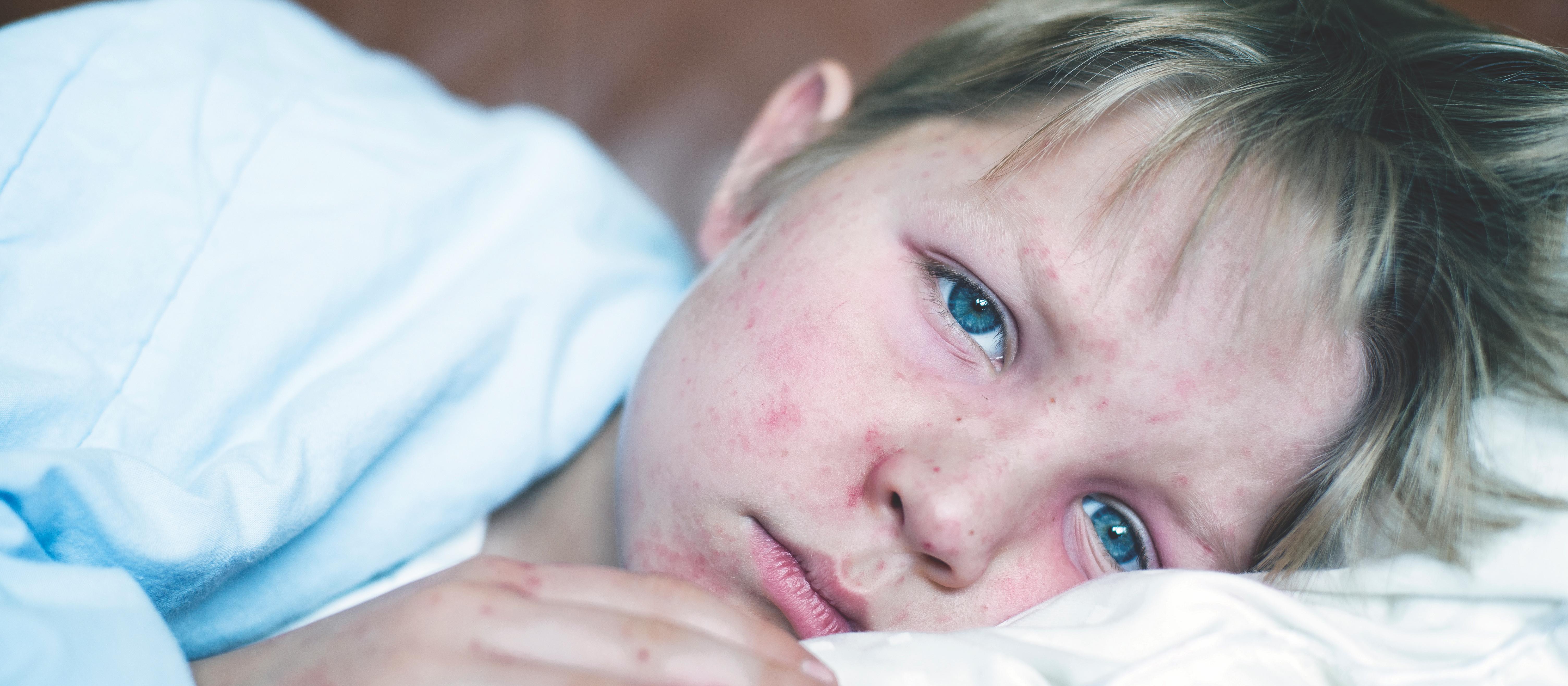 Boy with measles