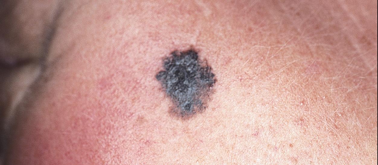 skin cancer