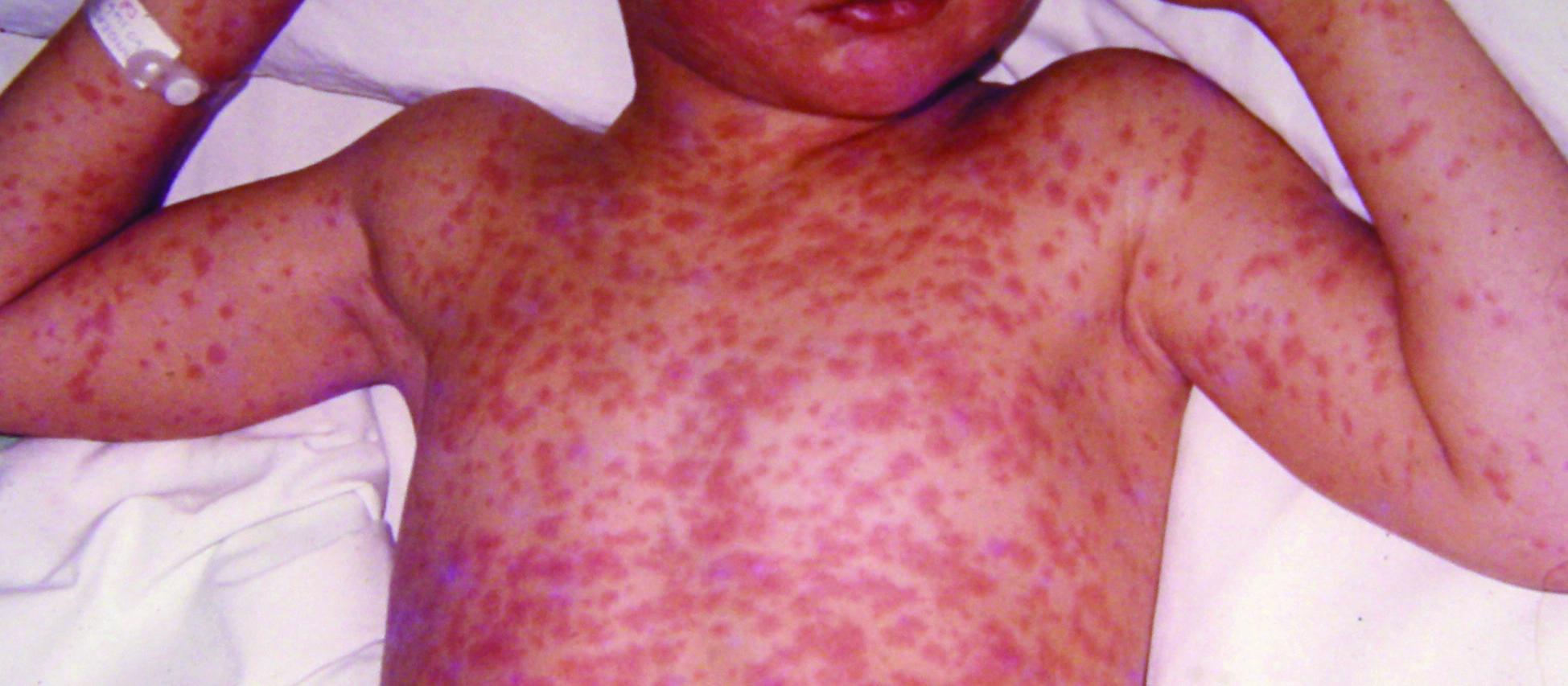 Child with measles