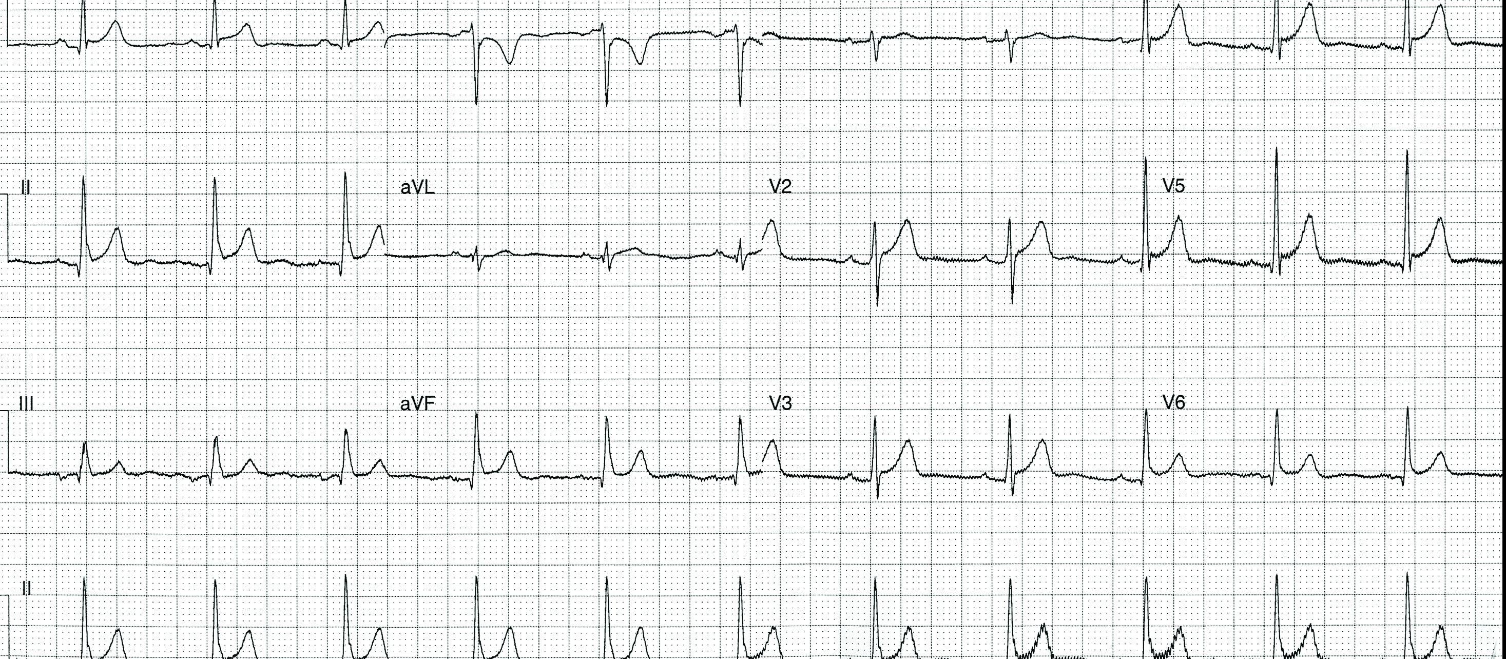 ECG Heartbeat