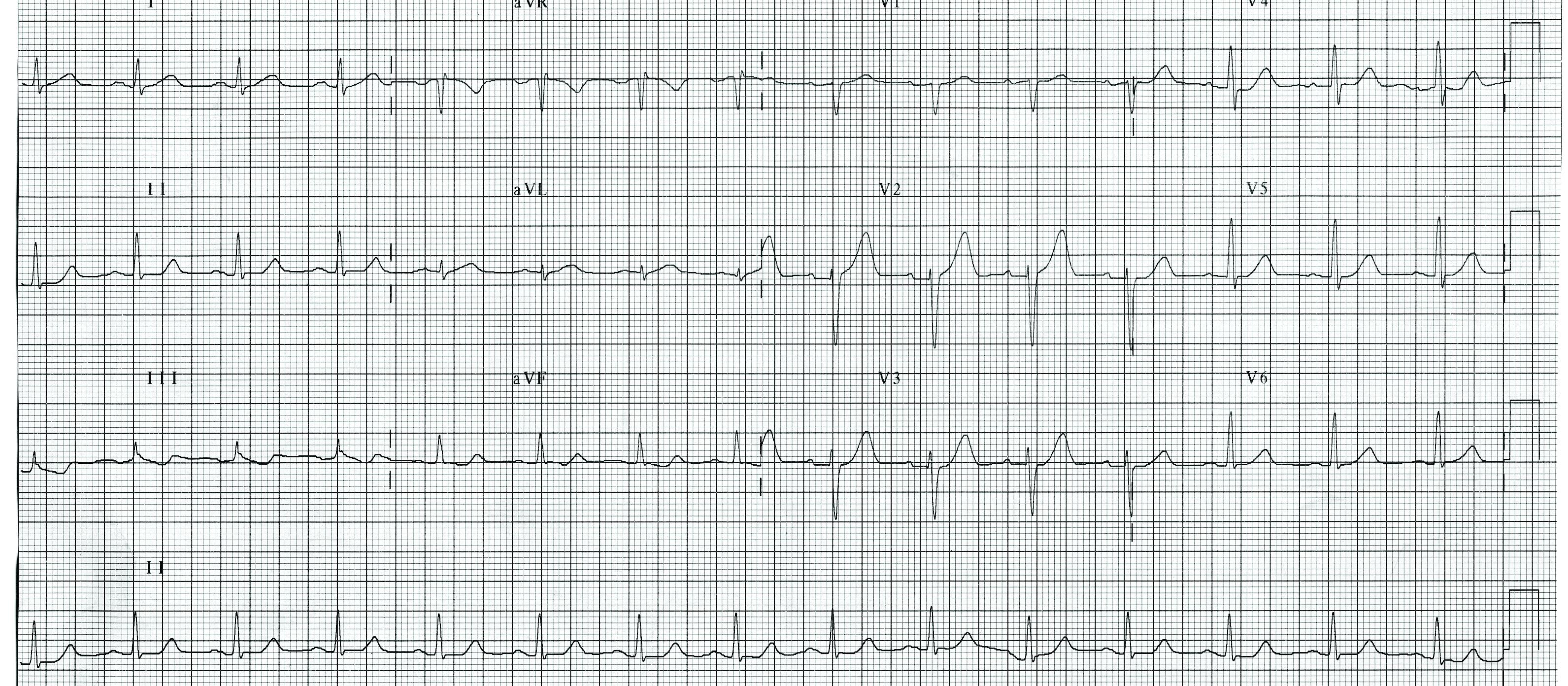 ECG Heartbeat 2011