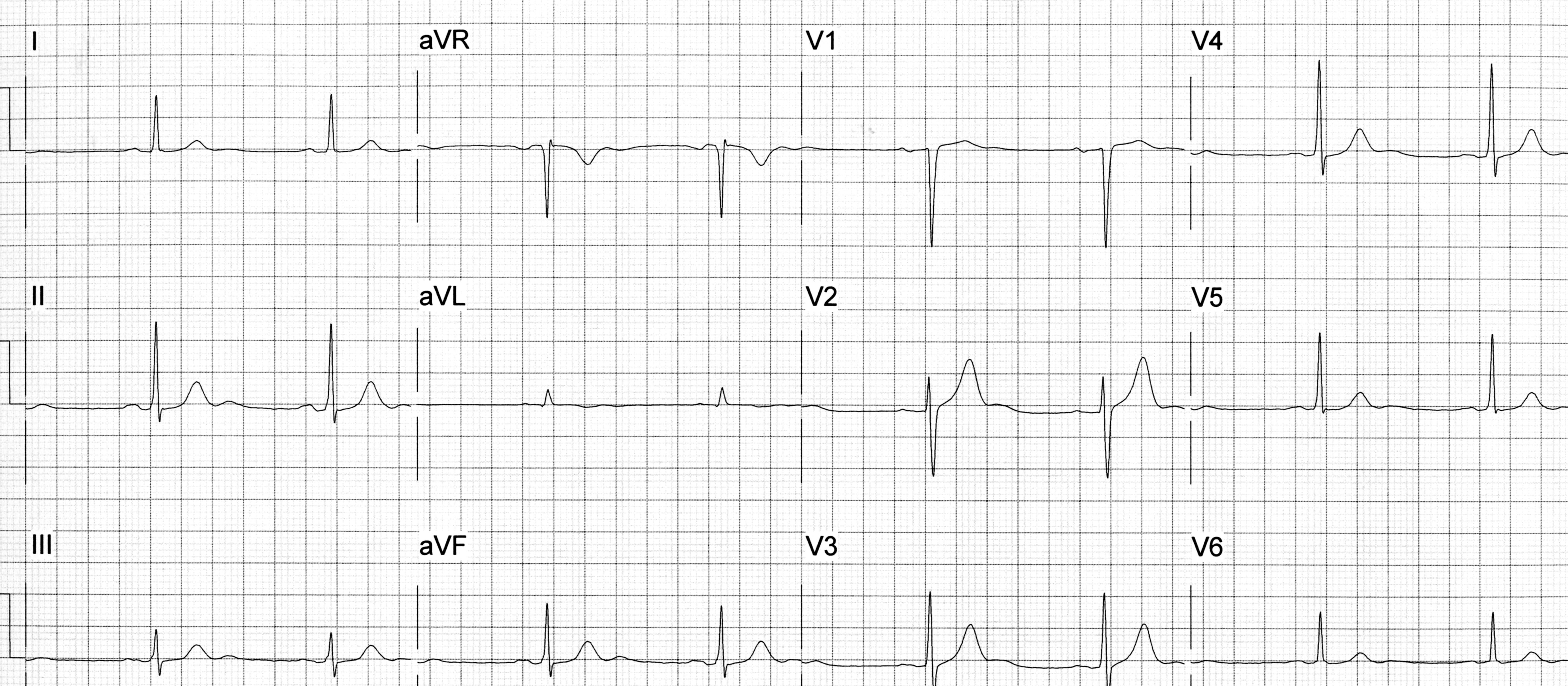 ECG heartbeat 12/2/20