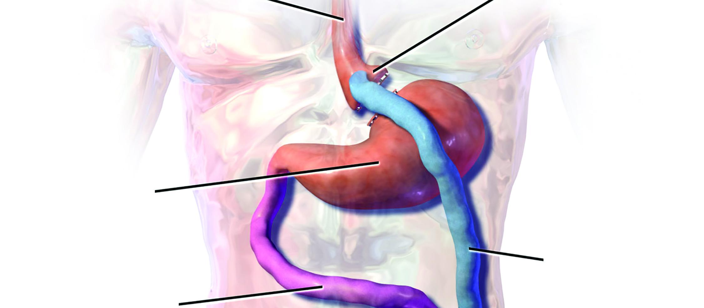 Gastric bypass using a Roux-en-T anastomosis