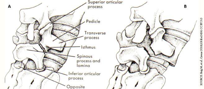 Lumbar vertebrae