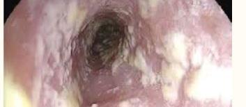 Oesophageal candidiasis and Circumferential ulceration in the midoesophagus,