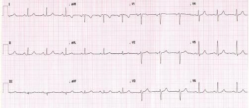 ECG heartbeat 2907