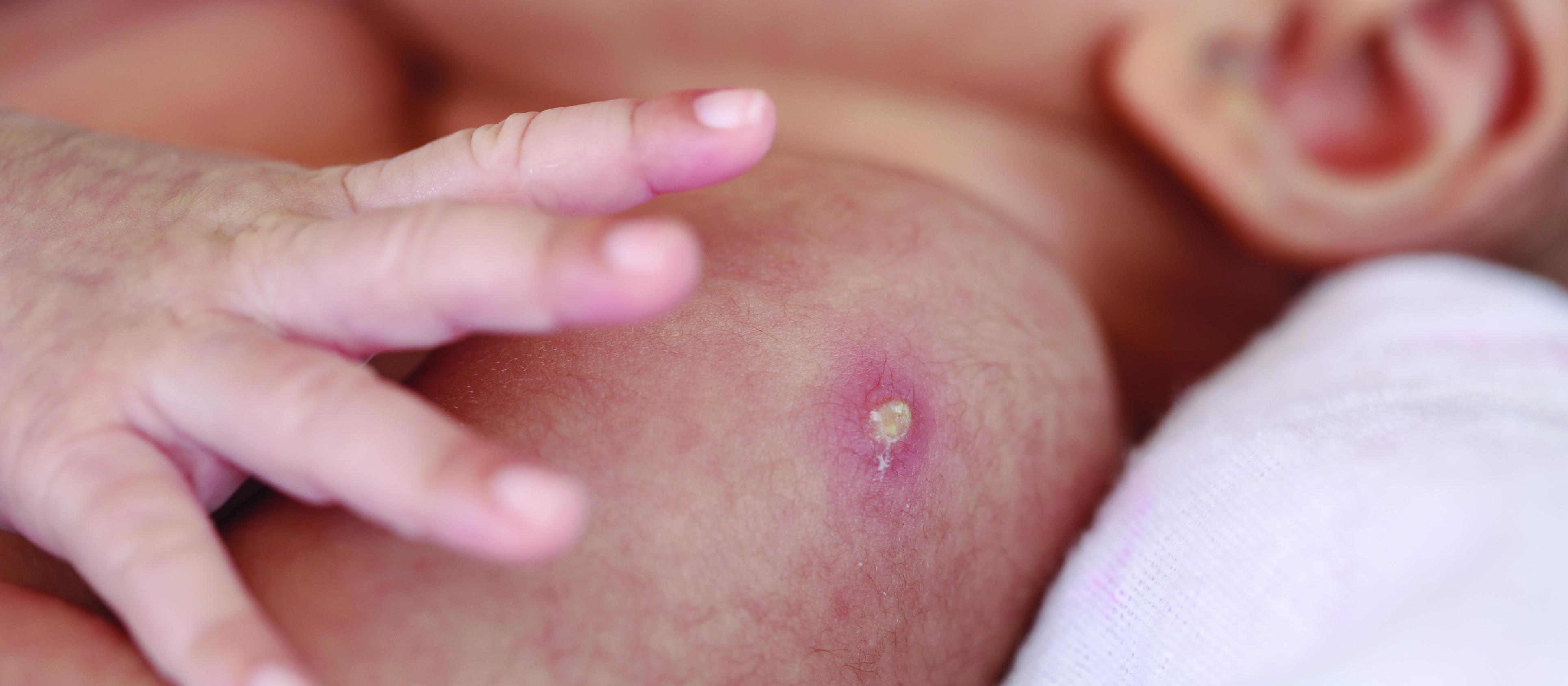 Pustules, BCG vaccination