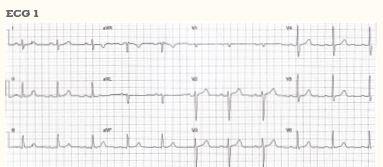 ECG Heartbeat 1908