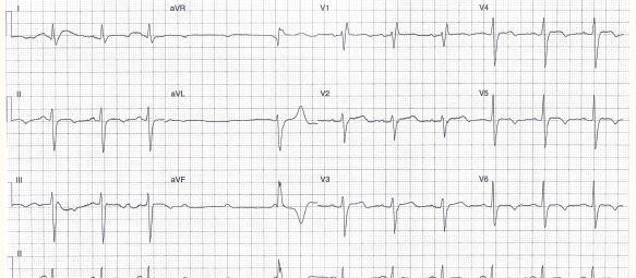 ECG Heartbeat 2209