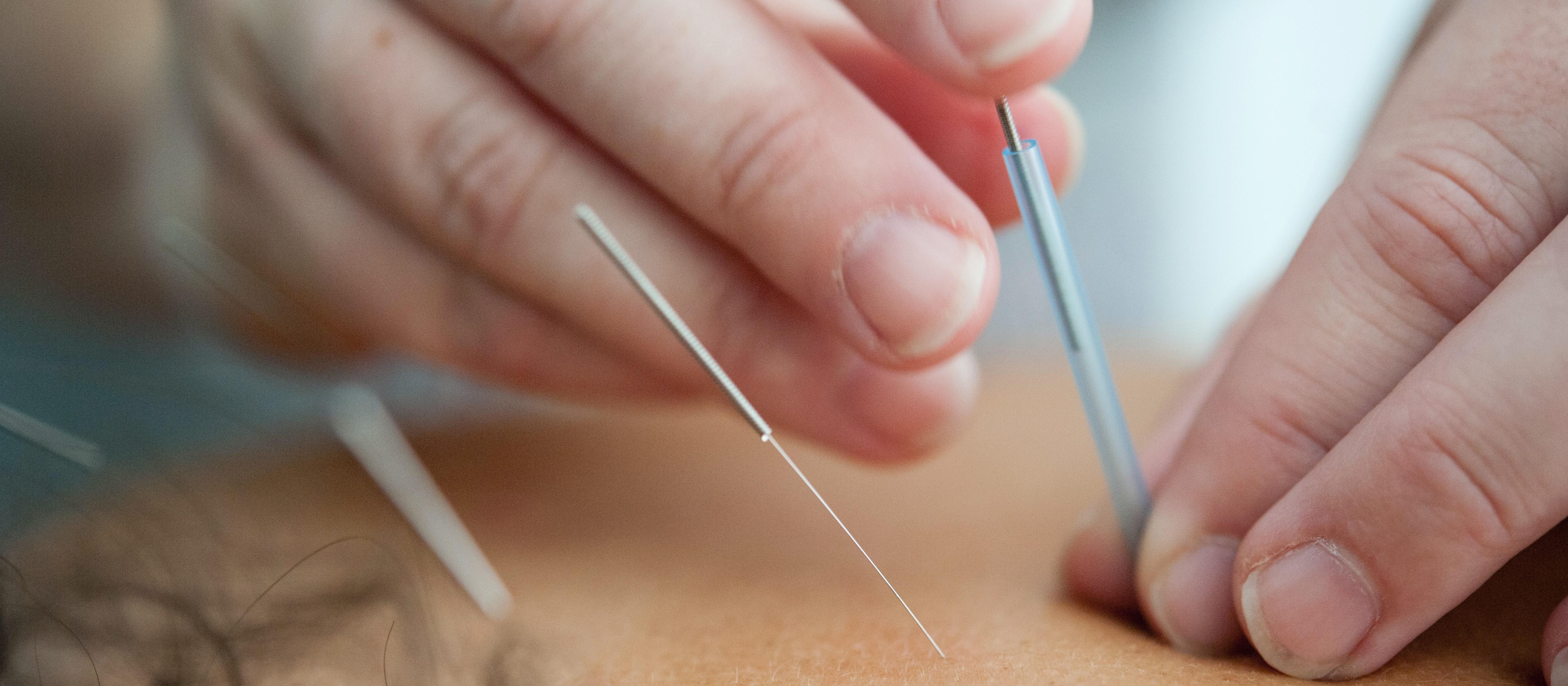 Acupuncture CR Katherine Hanlon / UnSplash