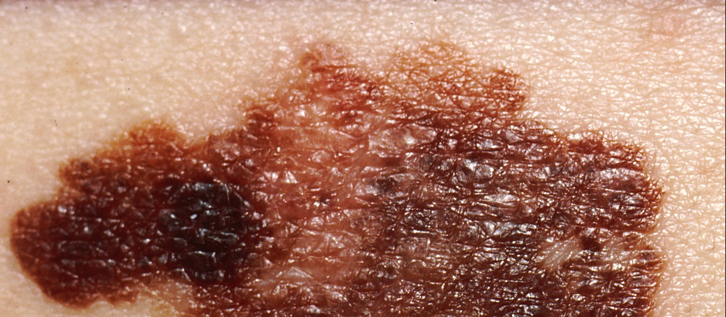 melanoma