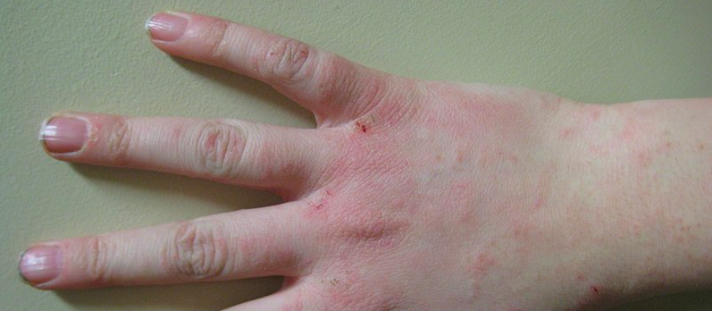 Healthline Rash