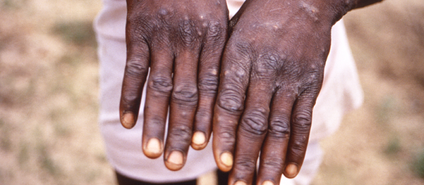 Monkeypox rash [image CDC]