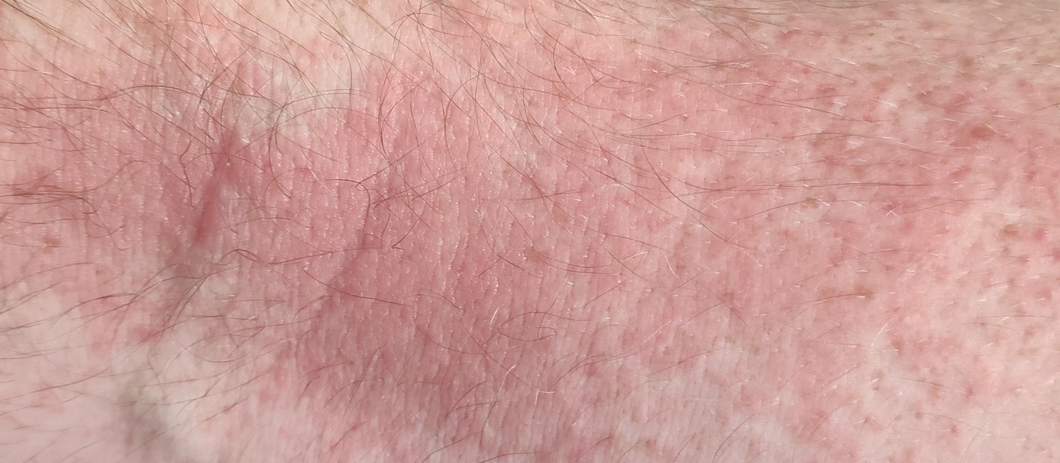 Mild atopic dermatitis