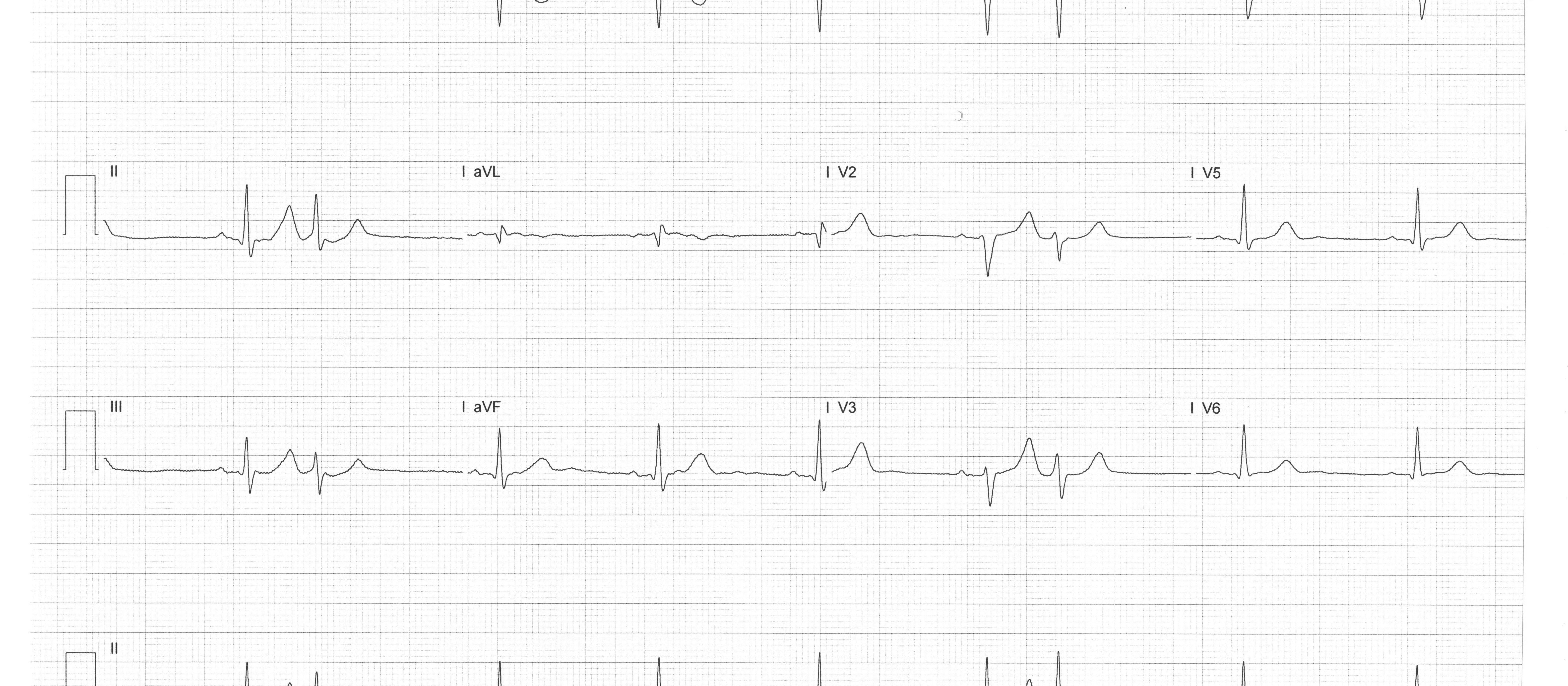 Heartbeat-2-Aug-2023-ECG