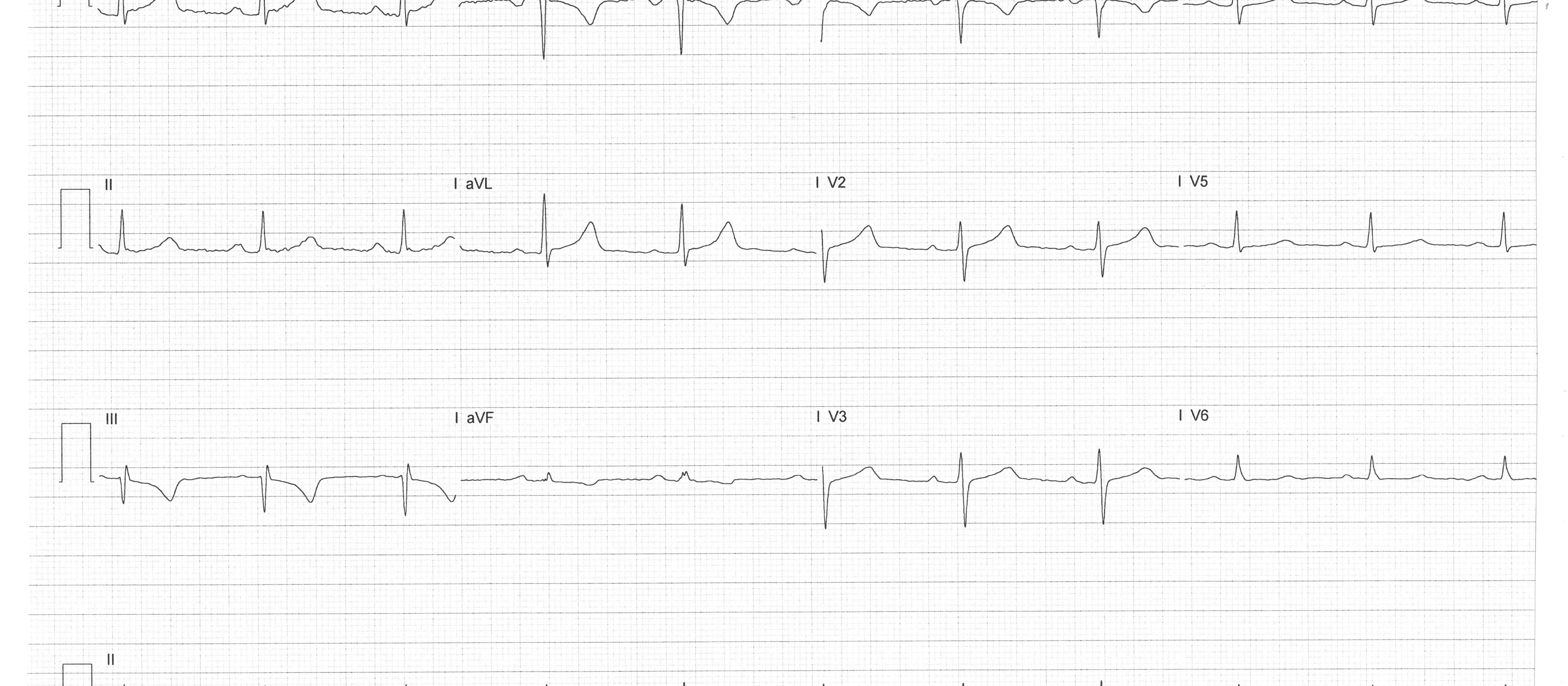 ECG