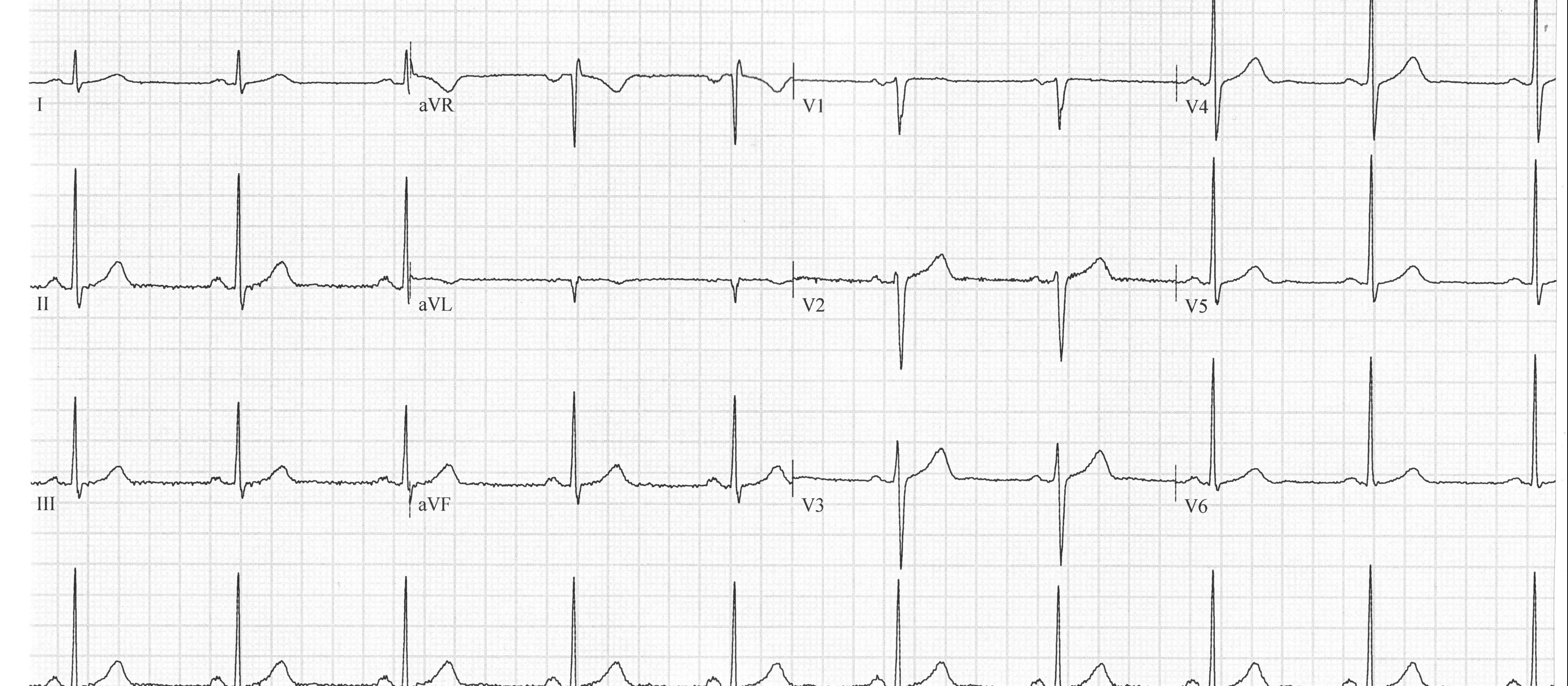 Heartbeat-ECG