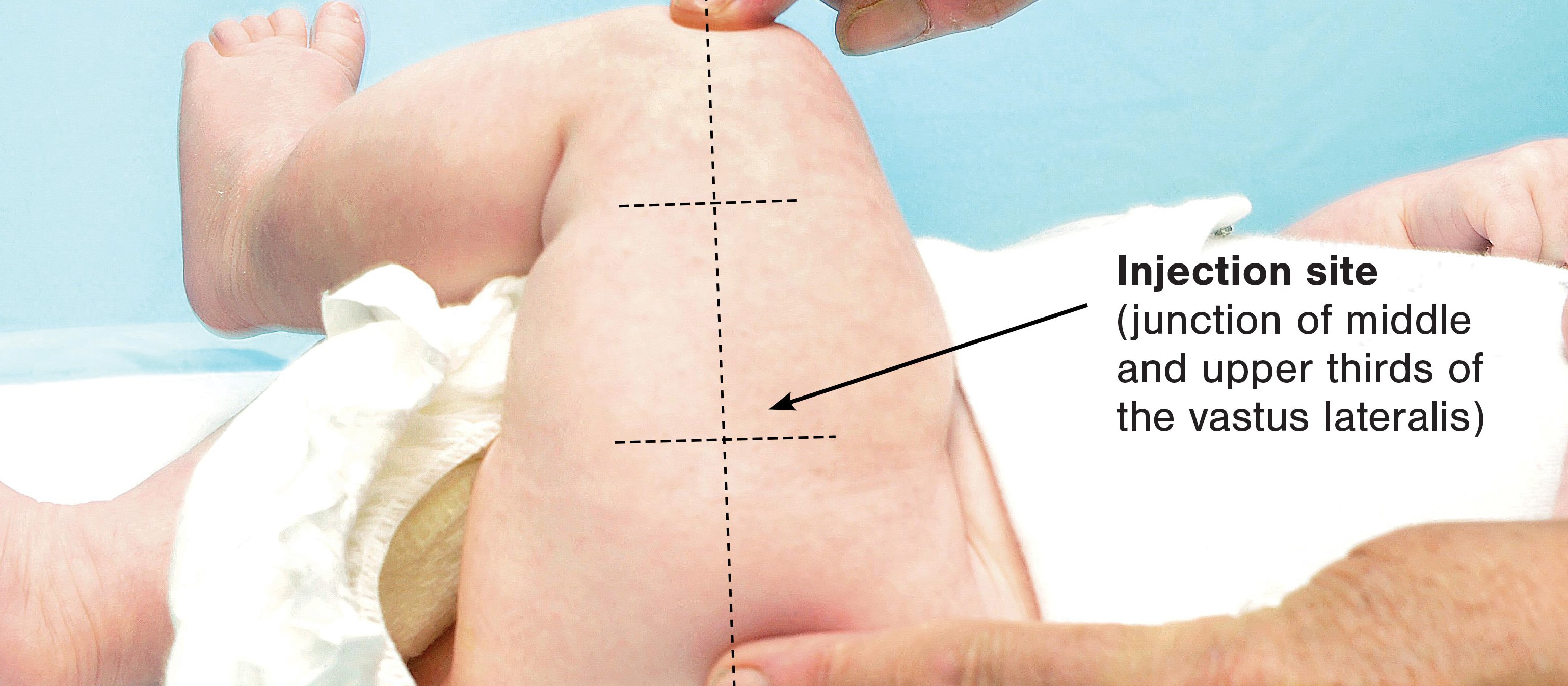 vastus lateralis injection