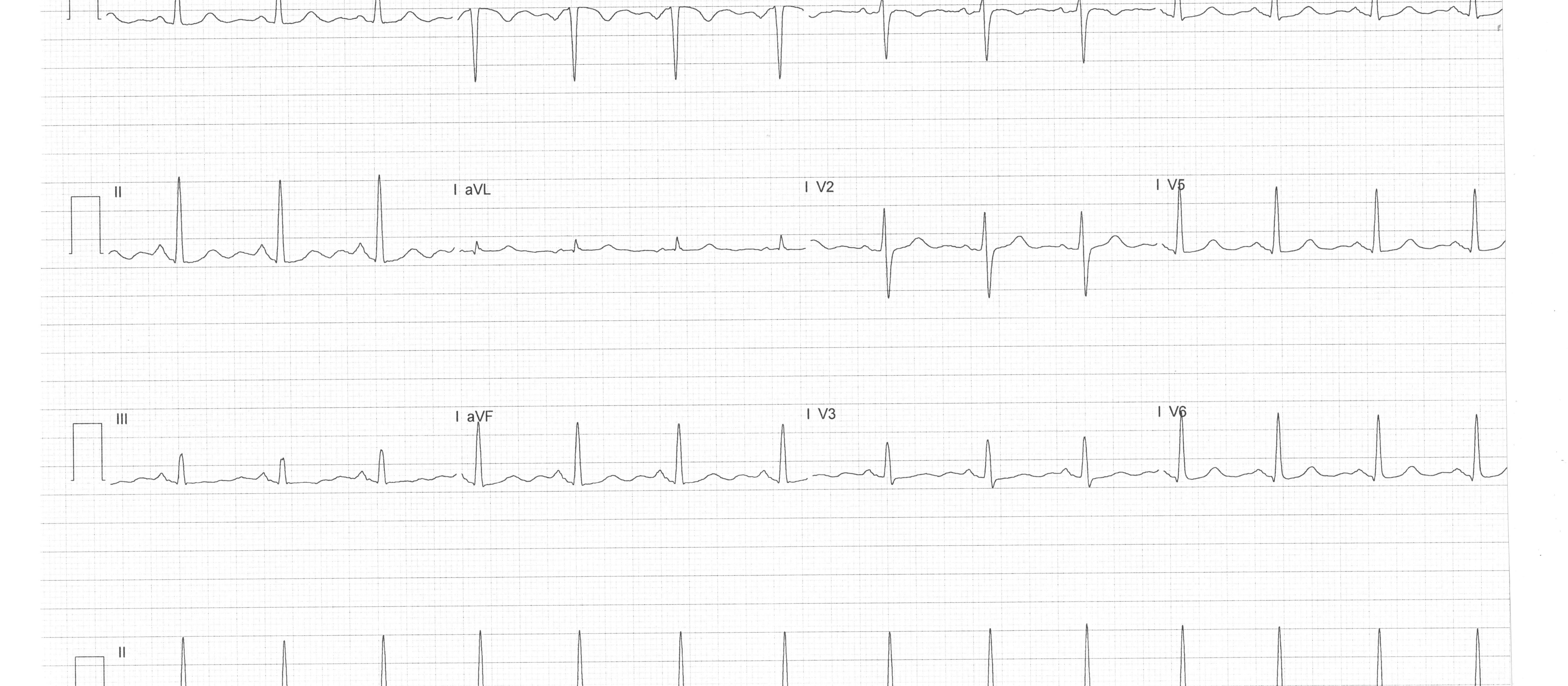 ECG