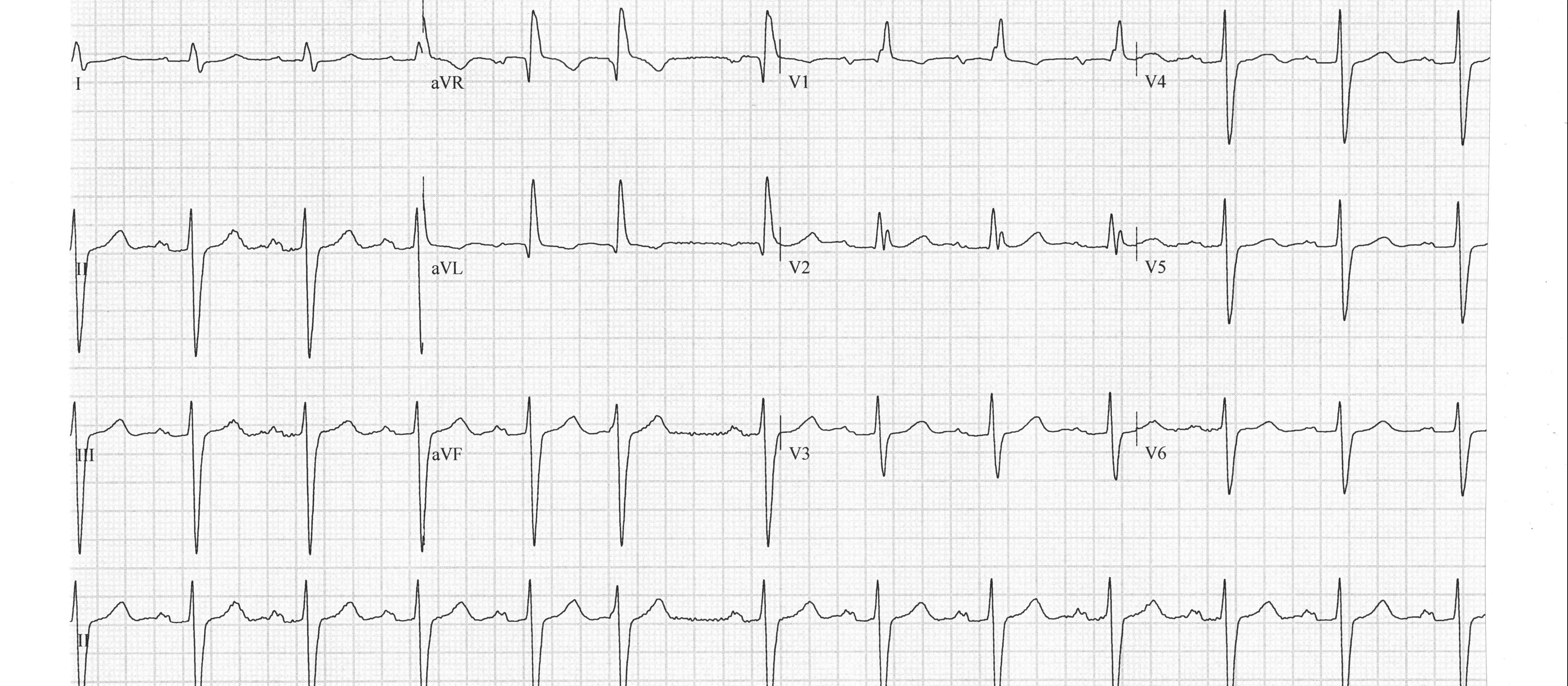 ECG