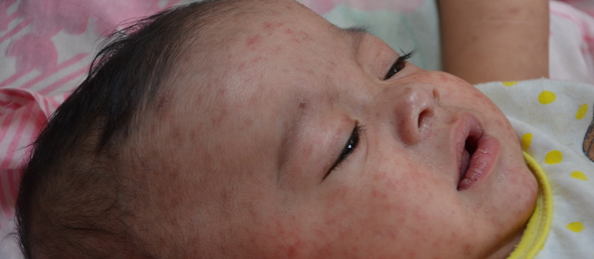 Child with measles