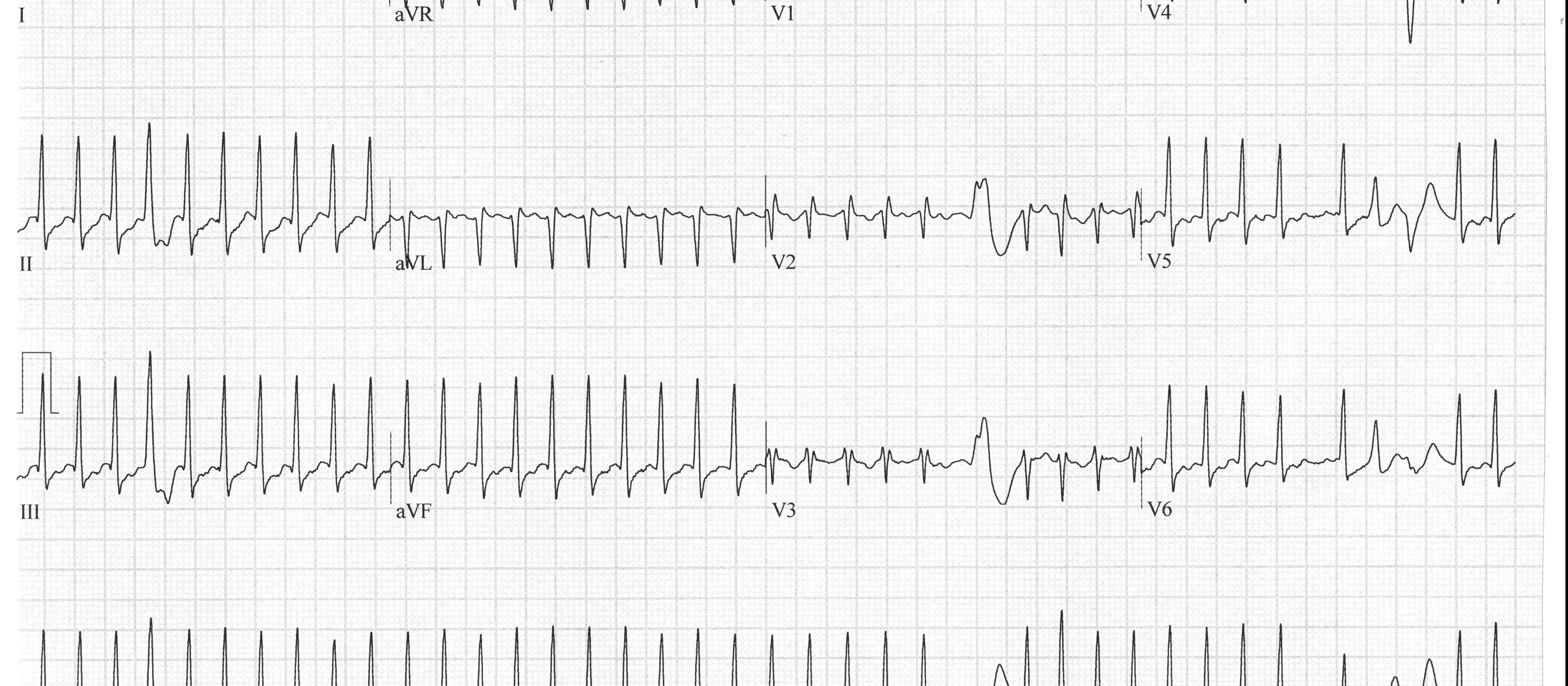 Heartbeat ECG