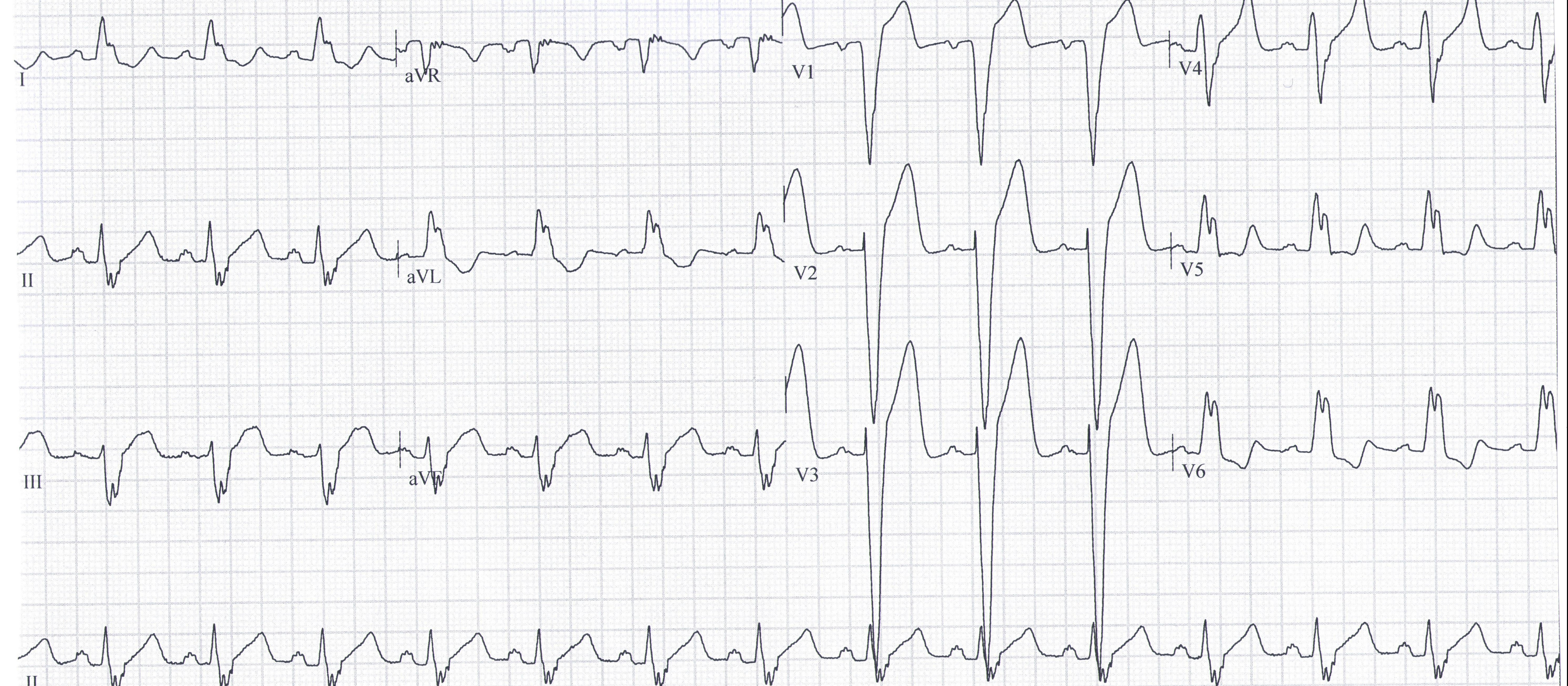 ECG