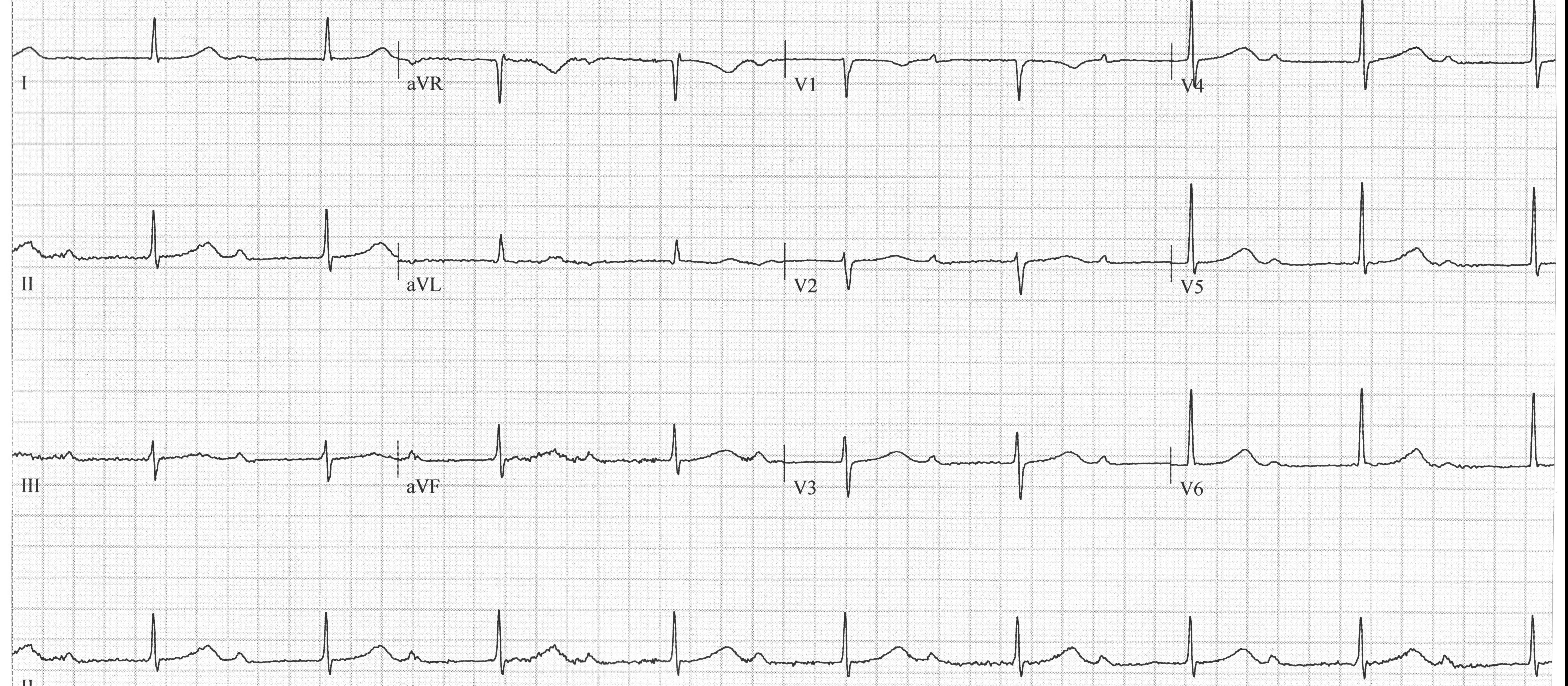 Heartbeat-ECG-10-Apr-2024