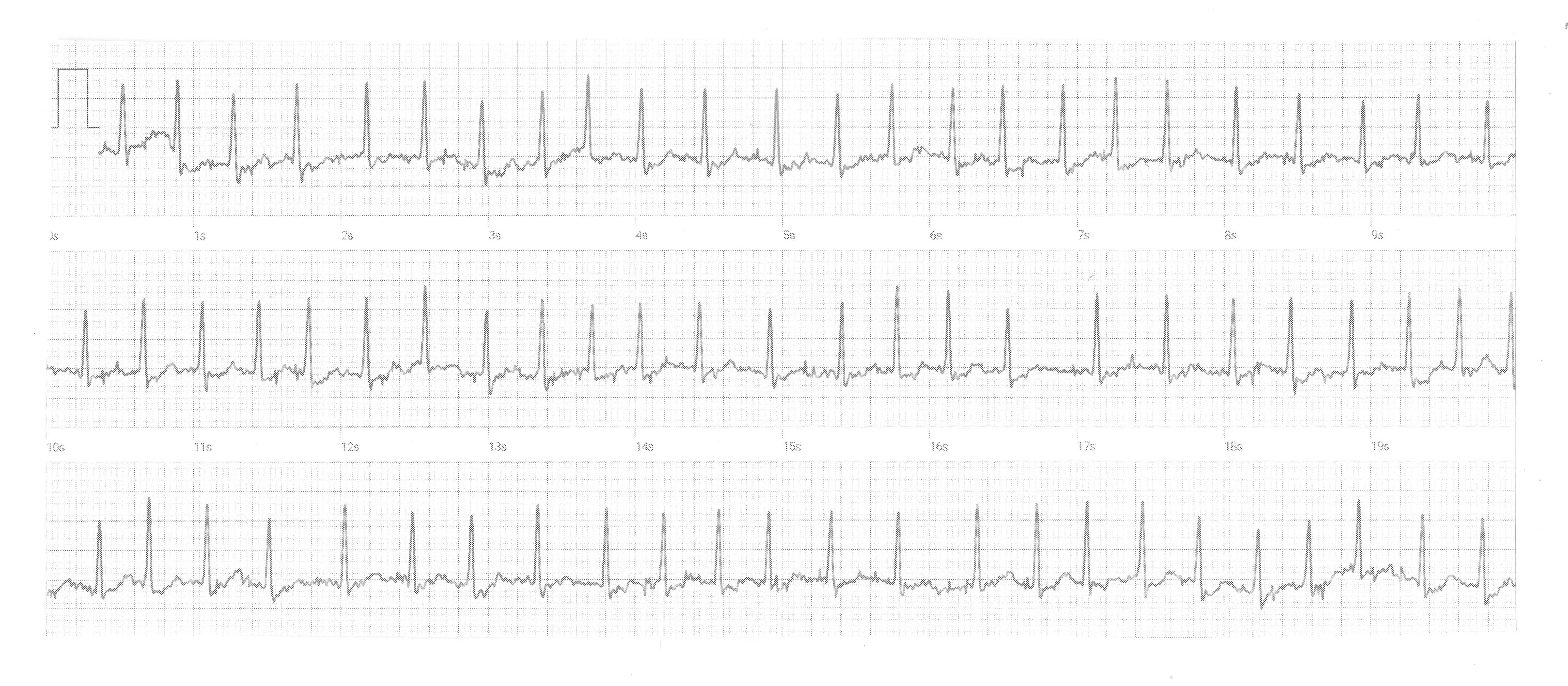 Heartbeat ECG