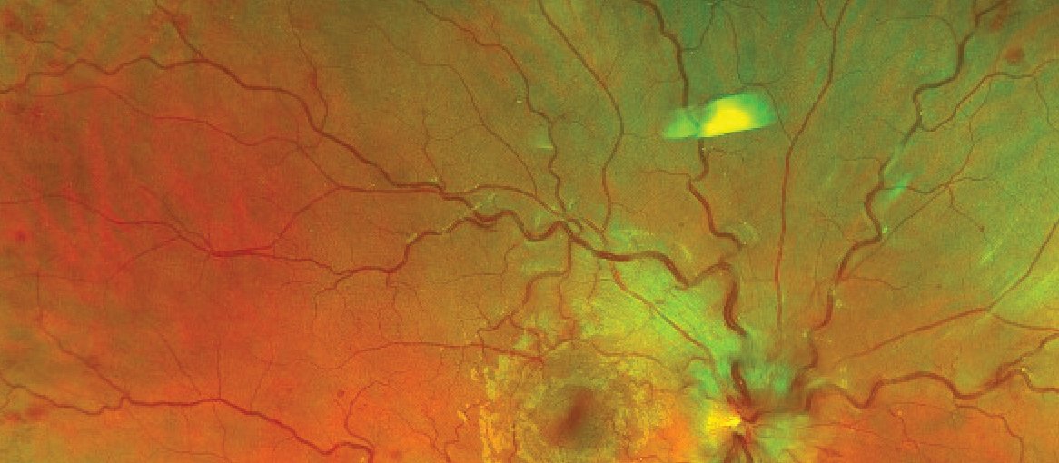 Figure-1-retinal-vein-occlusion