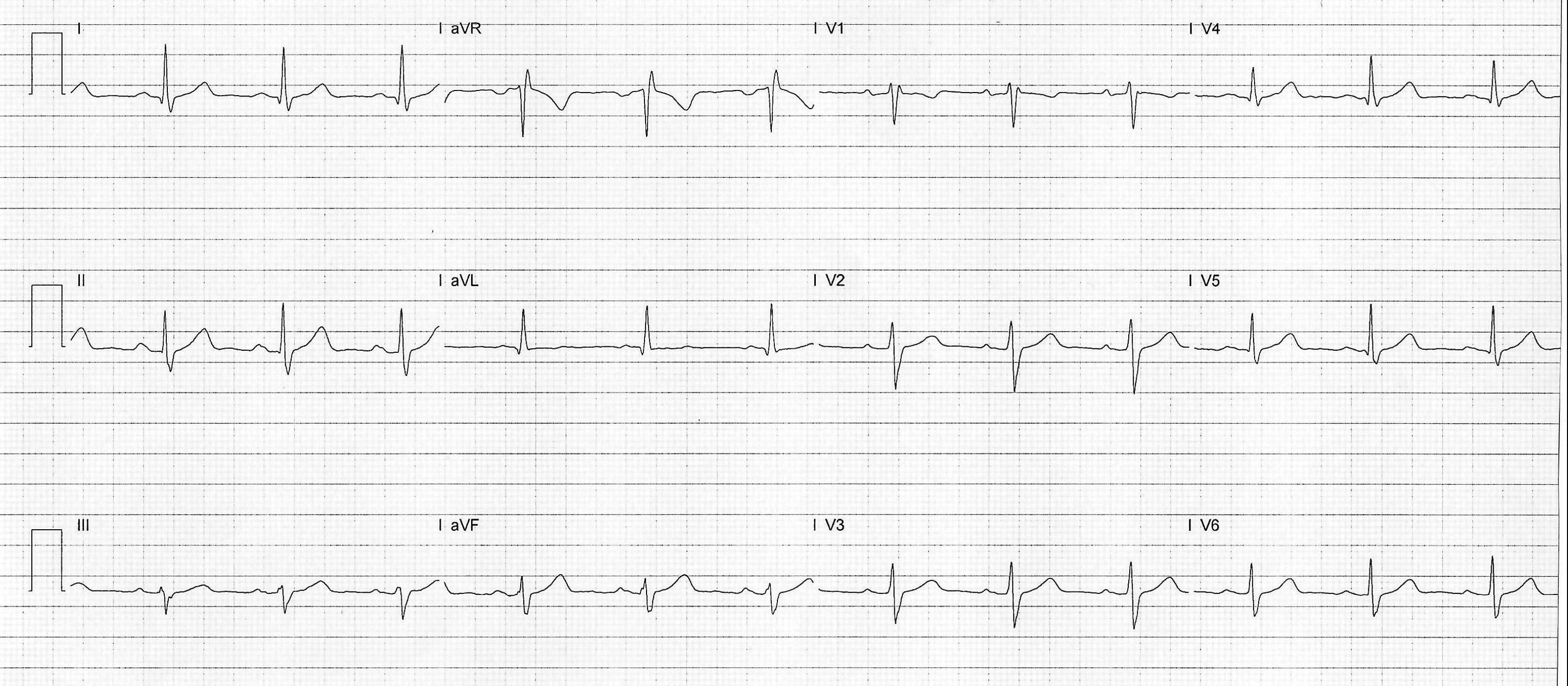 Heartbeat-ECG-25-Sep-2024