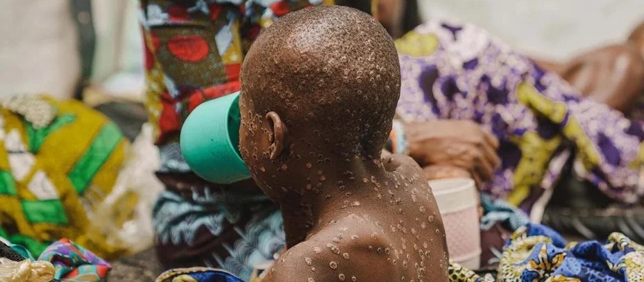 Mpox in the DRC [Image: Unicef]