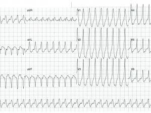 ECG