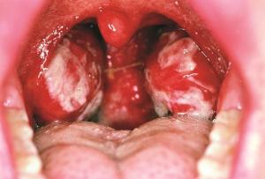 mouth, throat, dental, Epstein-Barr  virus glandular fever