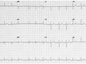 ECG 30 aug 2017