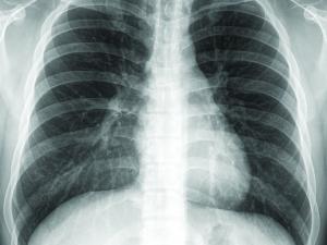 Chest x-ray