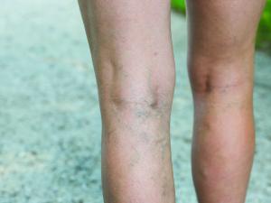 varicose veins