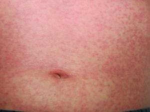 measles rash